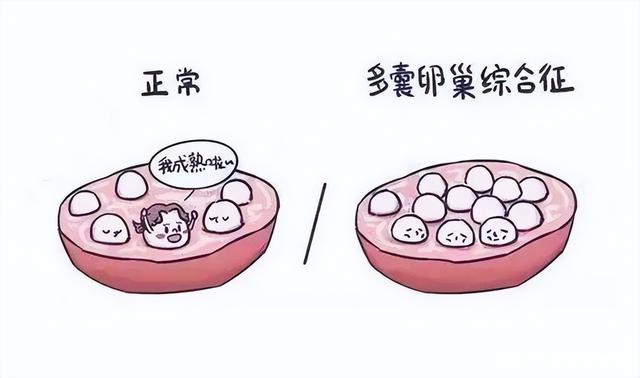 什麼是多囊卵巢綜合征？怎麼治療？