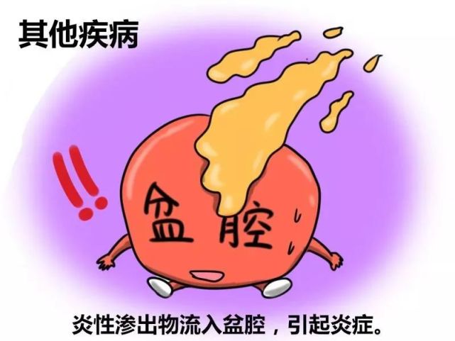 盆腔炎.jpg