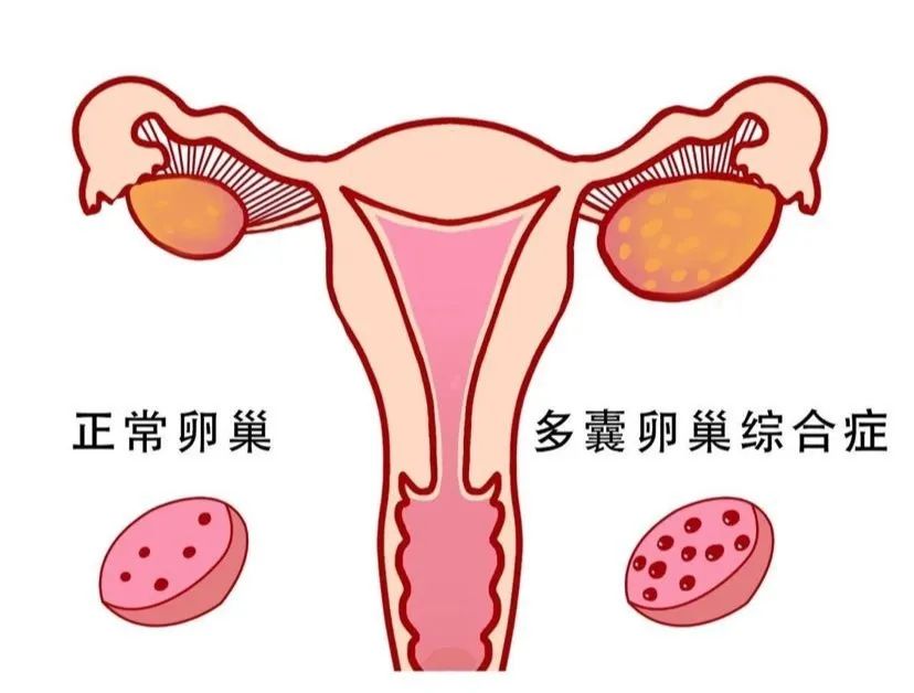 ​多囊卵巢綜合症與排卵障礙：女性如何進行診斷？